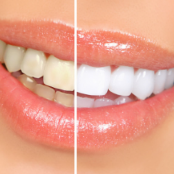 Clareamento Dental
